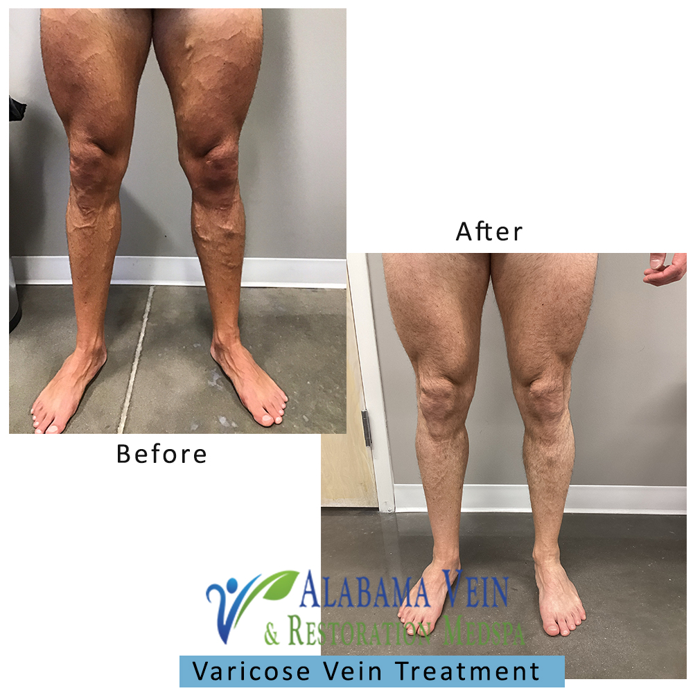 Varicose Veins