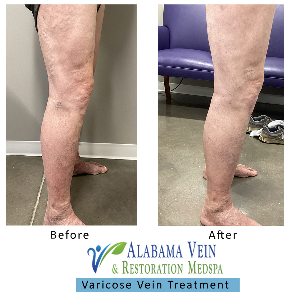 Varicose Veins
