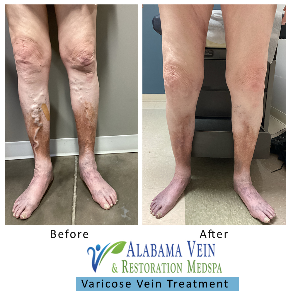 Varicose Veins
