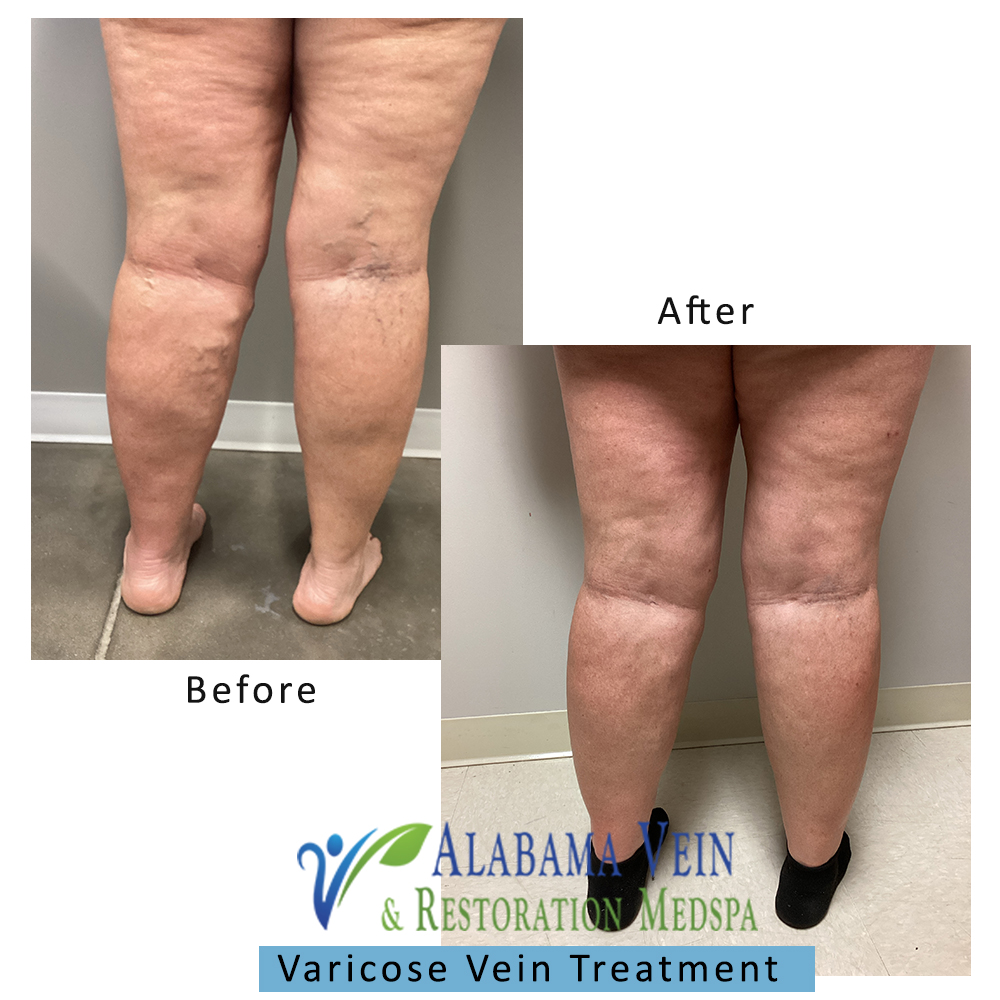 Varicose Veins