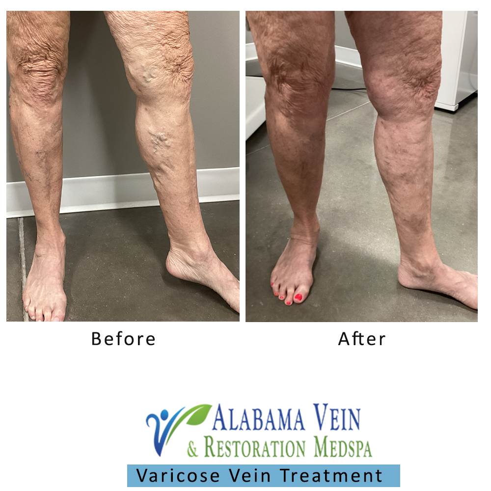 Varicose Veins