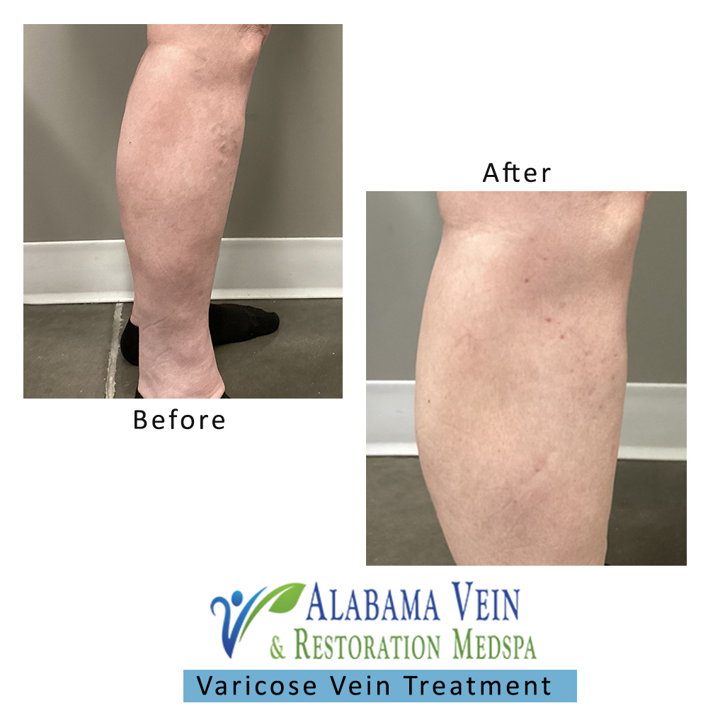 Varicose Veins