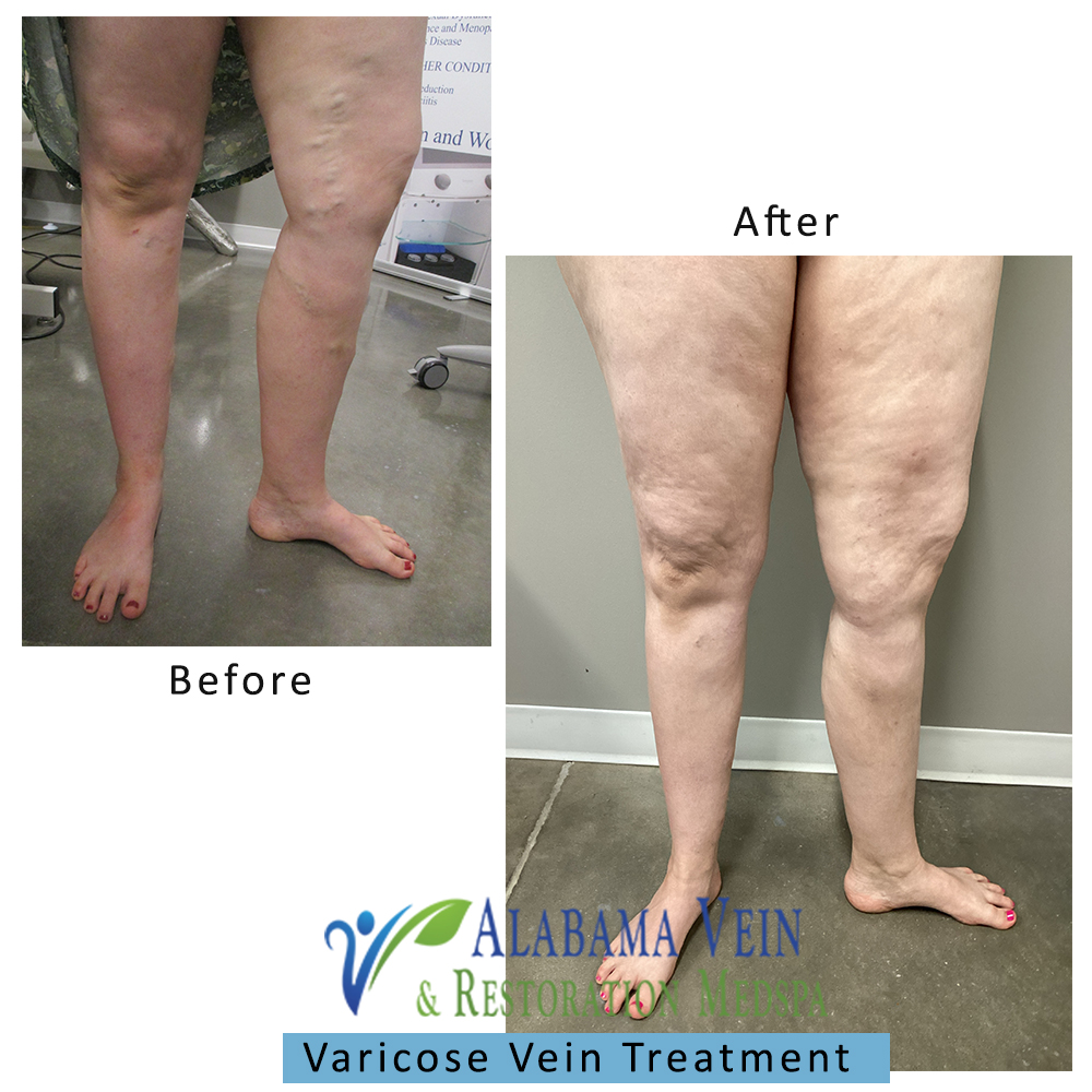 Varicose Veins